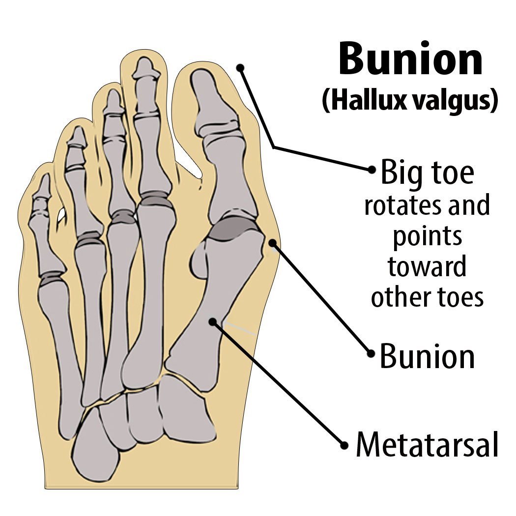 2018 New Massage Ball BigToe Protector Stretcher Bunion Valgus Hallux Corrector Kits Footcare